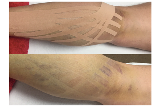Does Kinesiology Taping Really Help Bruises Heal Faster? The Truth Behind the Taping Effect